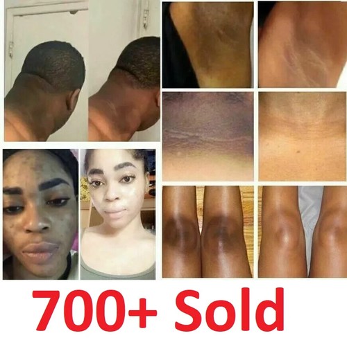 Dark skin bleaching cream - skin,