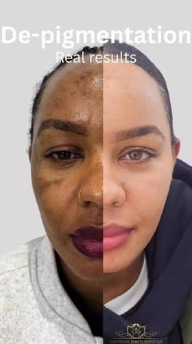 Fast skin whitening bleaching - skin,